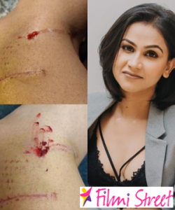 Actress Aanchal Khurana attacked by 3 street dogs
